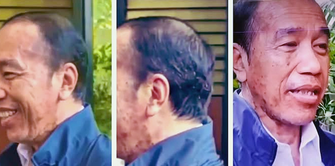 Jokowi Sakit karena Tekanan Isu Ijazah Diduga Derita Autoimun dan Hormon Tak Stabil